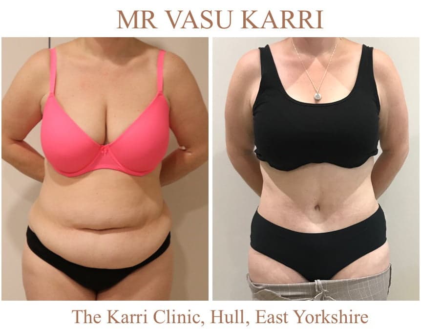 Brazilian Tummy Tuck (Lipo Abdominoplasty)