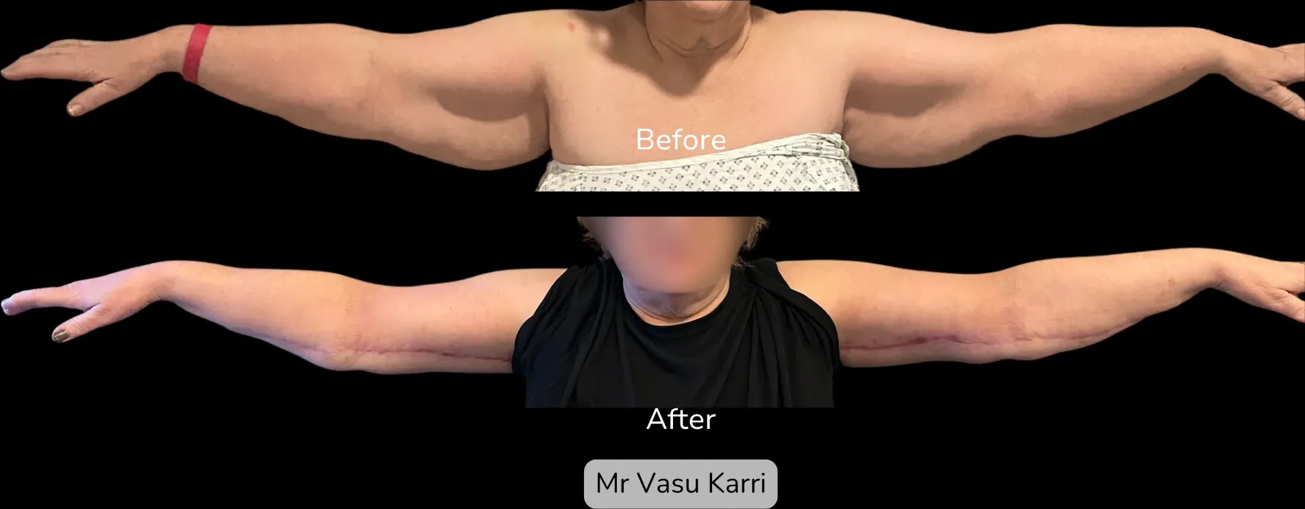 Arm Lift photo