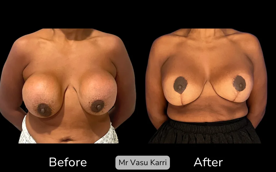 Capsular Contracture photo