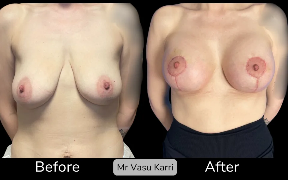 Breast Enlargement and Lift photo