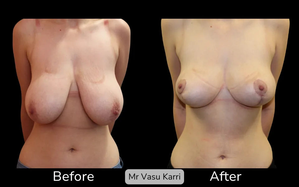 Breast Lift photo