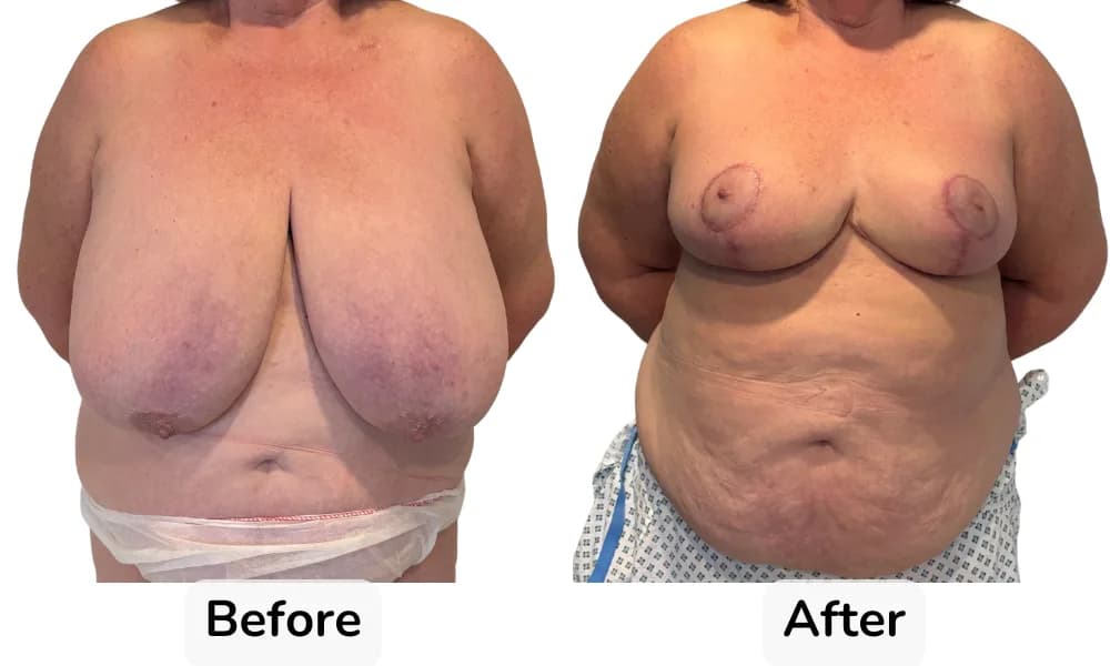 Breast Reduction photo