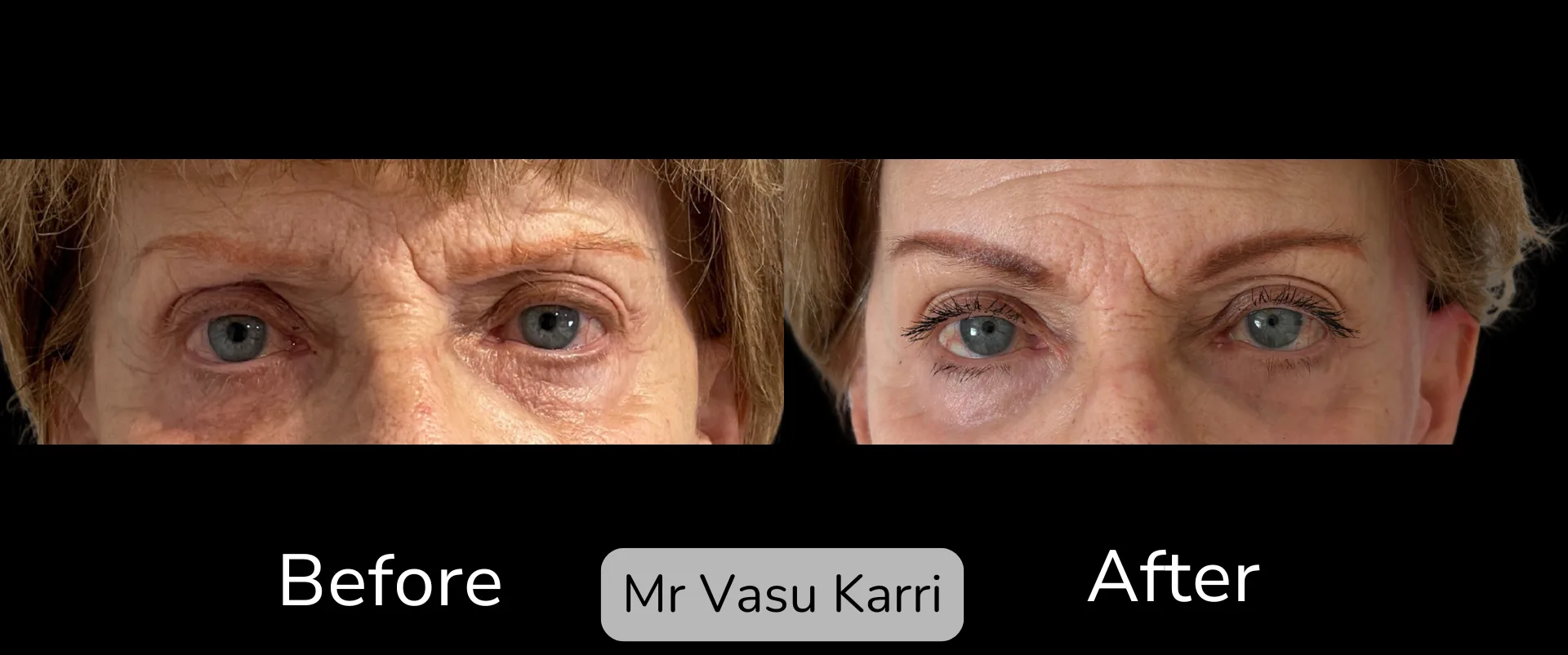 Brow Lift photo