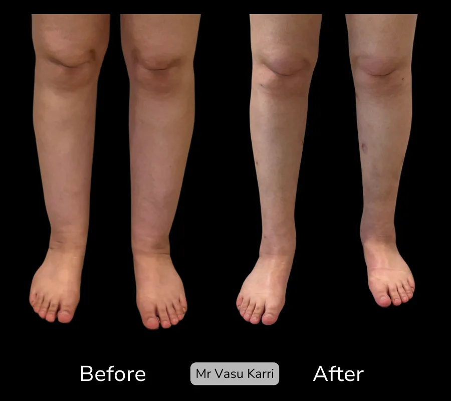 Cankle Surgery photo