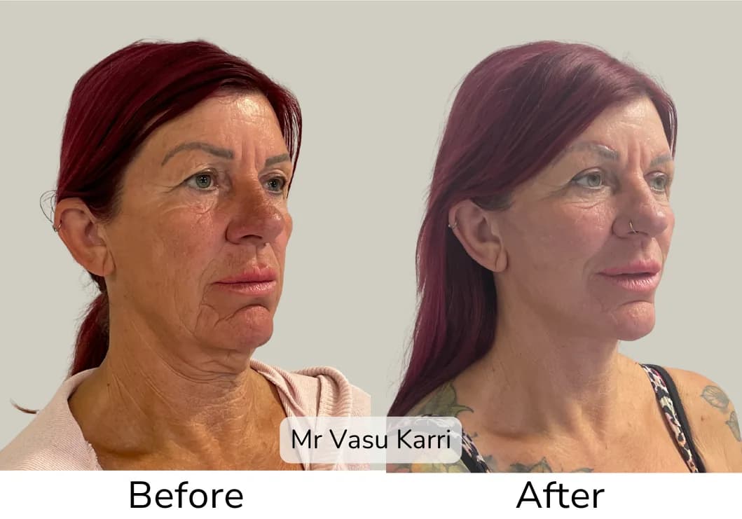 Phenol Peel photo
