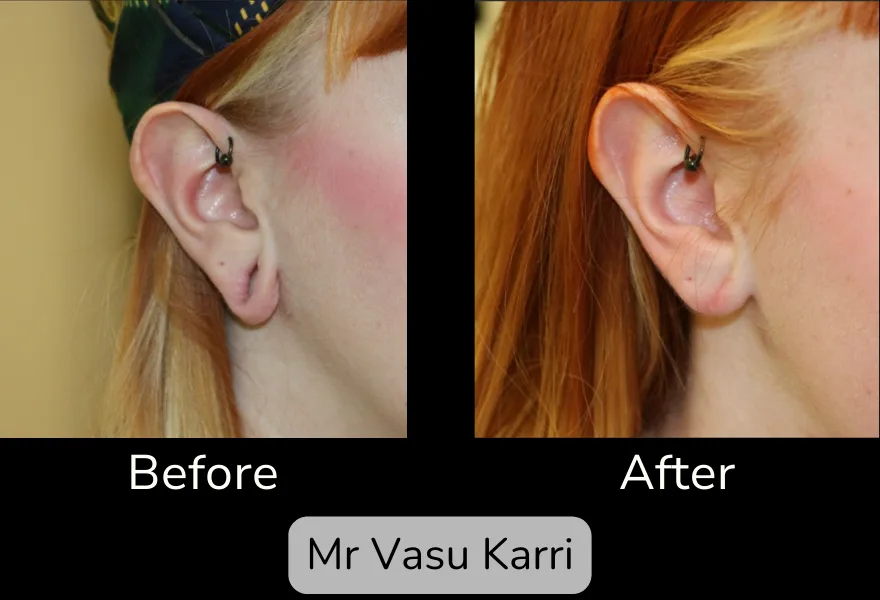 Earlobe Repair photo