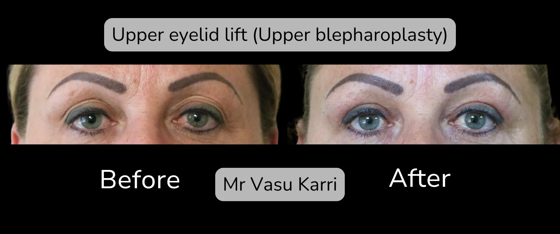 Eyelid Surgery photo