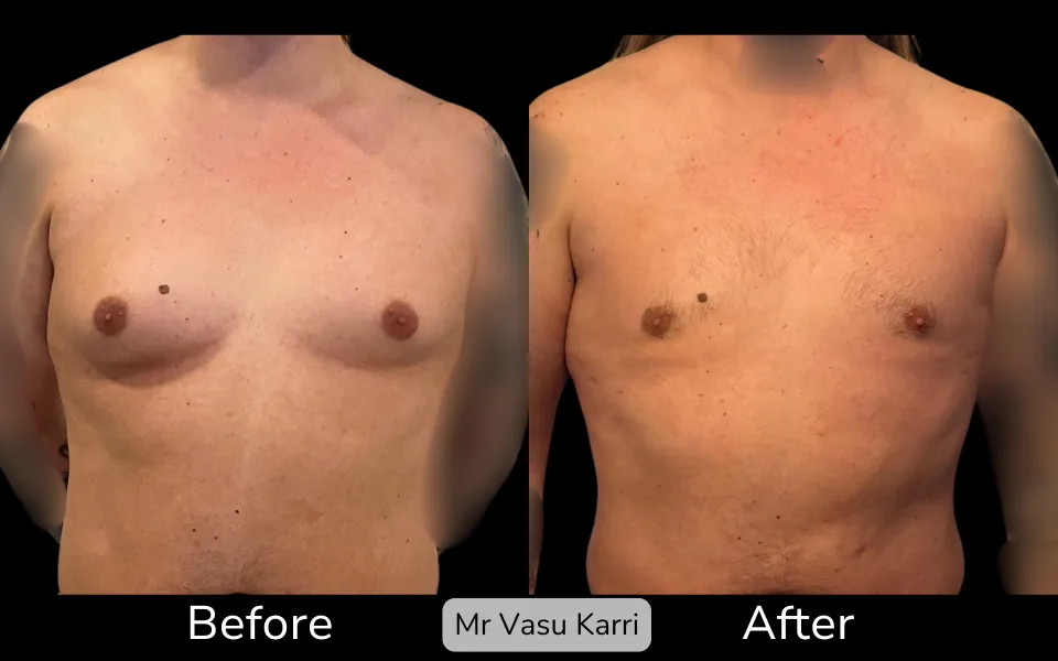 Gynaecomastia photo