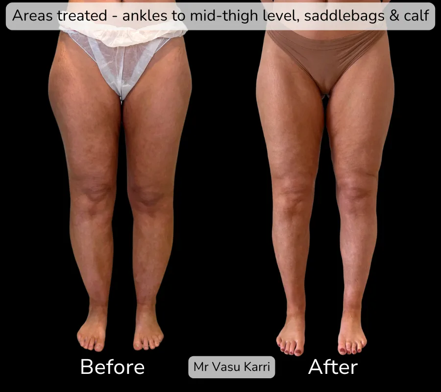 Stage 1 Lipoedema photo