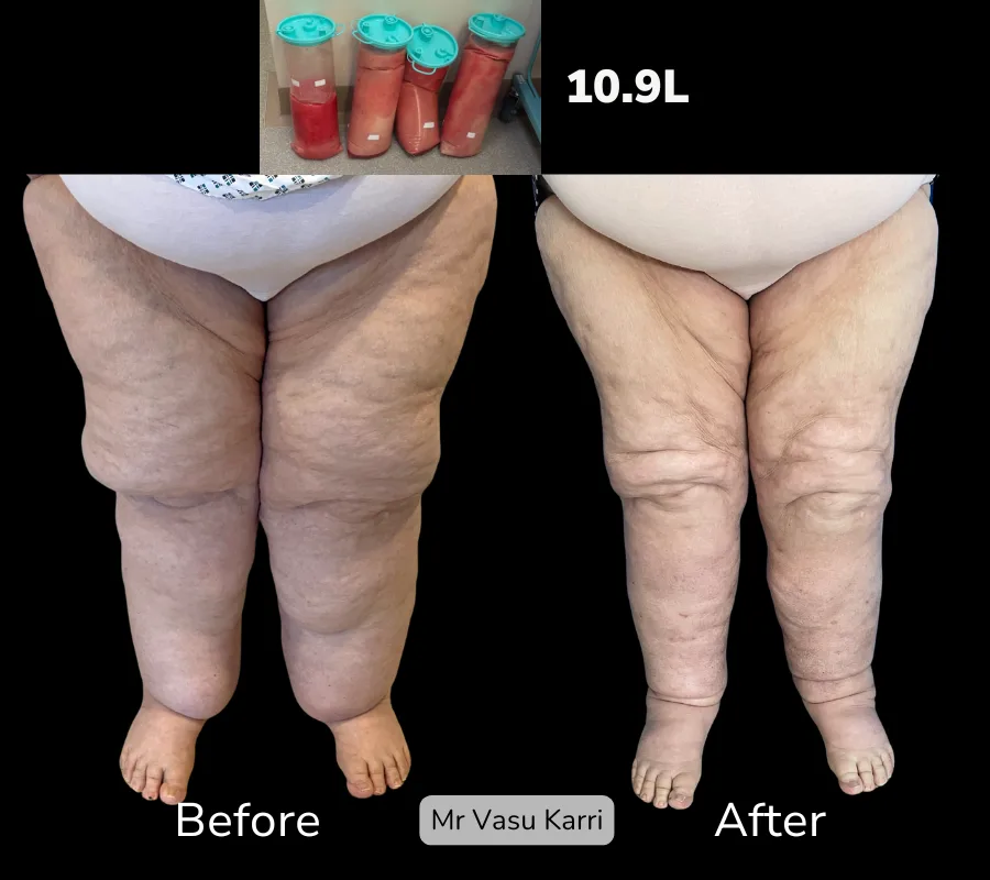 Stage 3 Lipoedema photo
