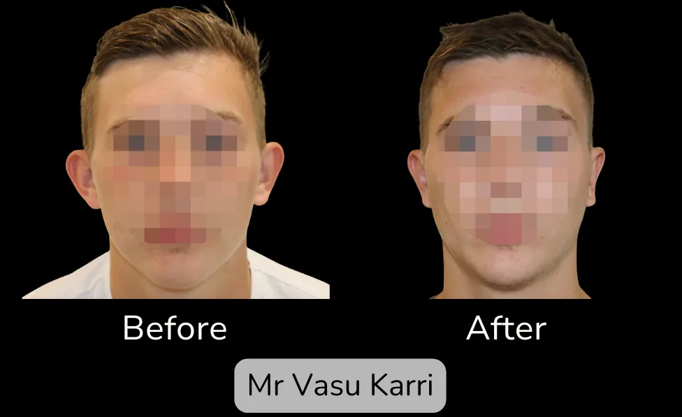 Prominent Ear Correction photo