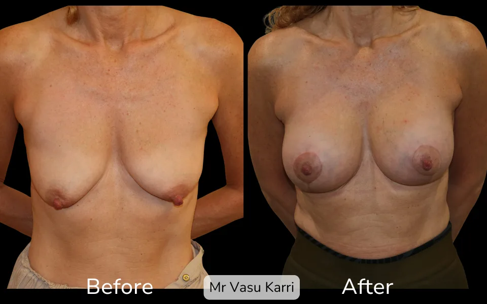 Tuberous Breast photo