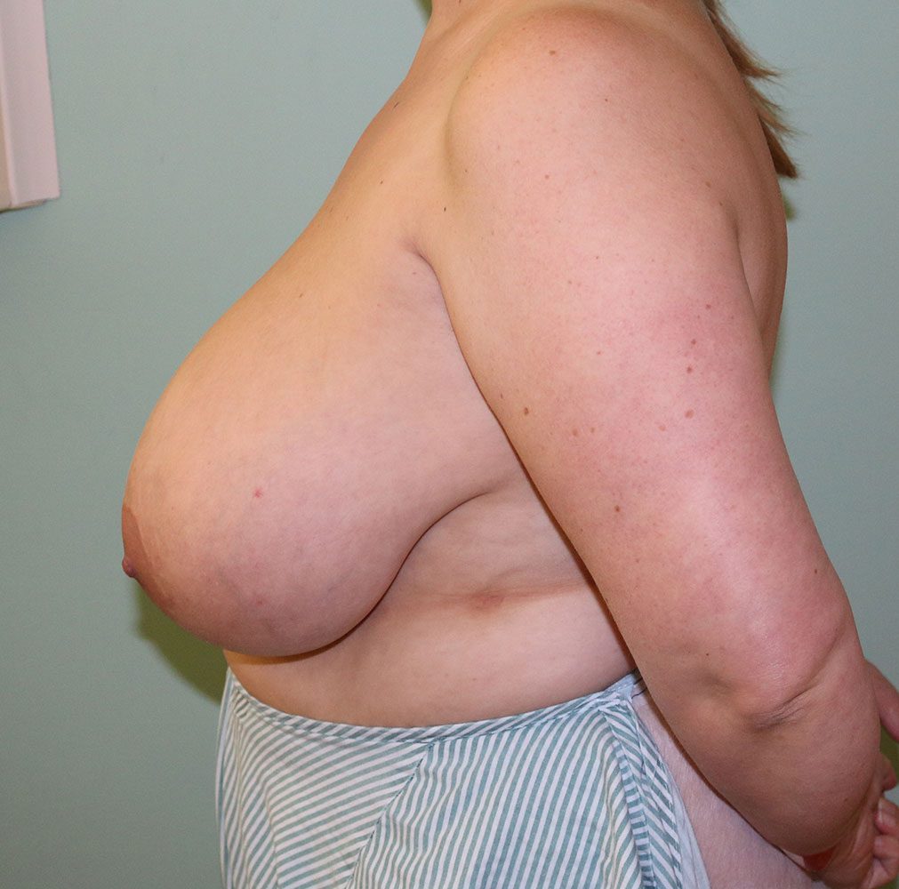 breast reduction before left lateral.