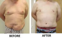 Tummy Tuck (Abdominoplasty) & Male Breast Reduction before and after AP view