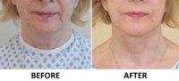 Facelift, necklift, phenol peel before and after AP view