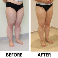 Lower limb lipoedema liposuction before and after right oblique view
