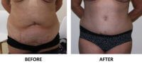 Tummy tuck before and after AP view