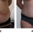 Tummy tuck before and after AP view