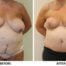 Symmetrising breast reduction and Brazilian tummy tuck AP view